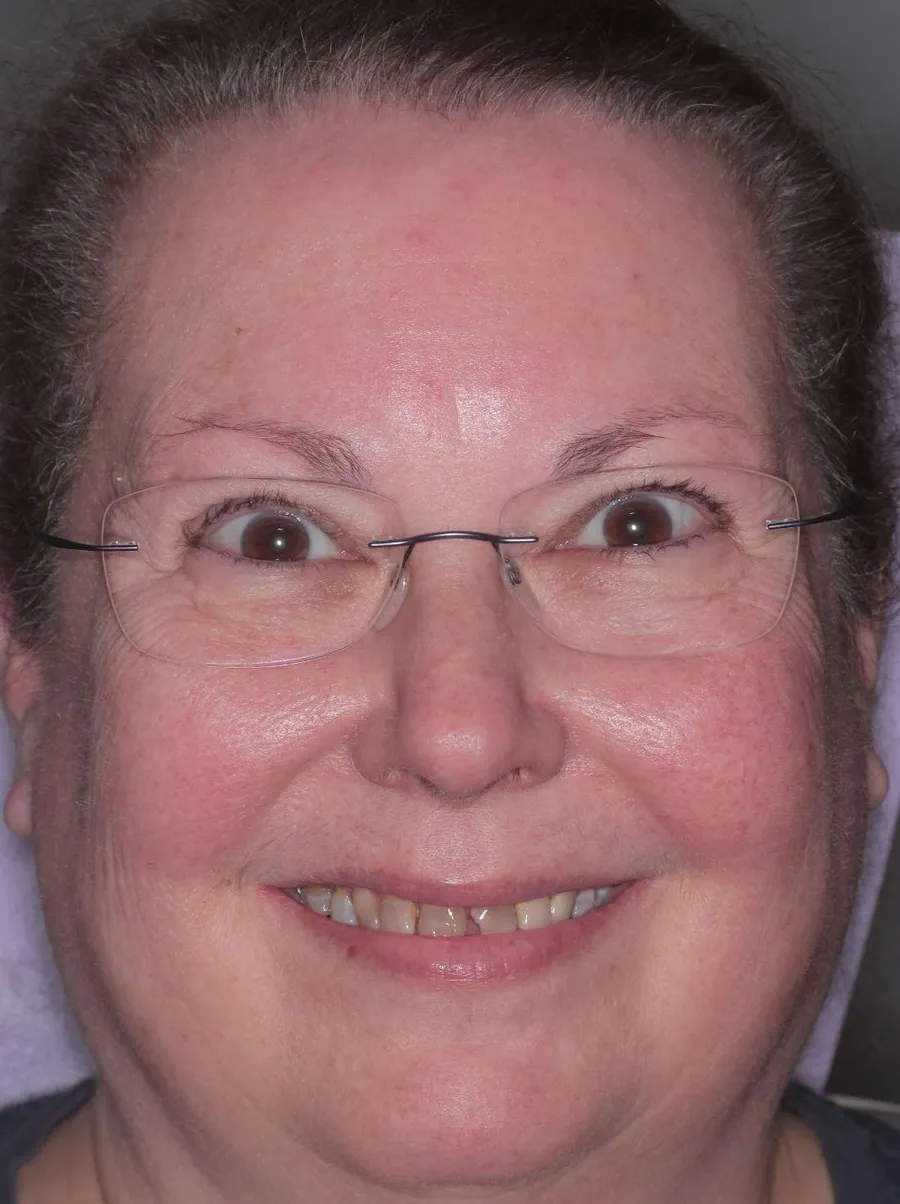 Before: chipped, worn and discolored teeth