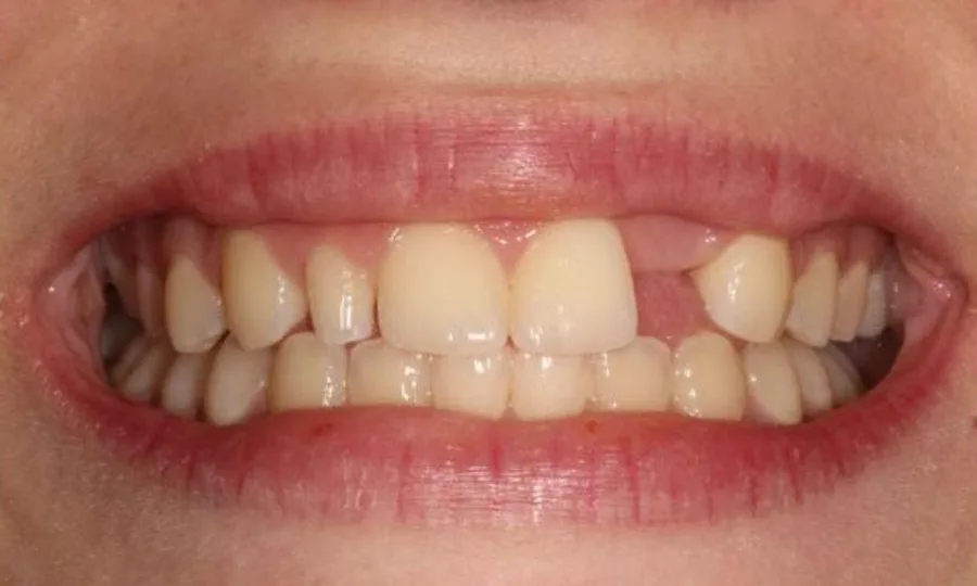 Before: one missing lateral incisor and a small peg tooth