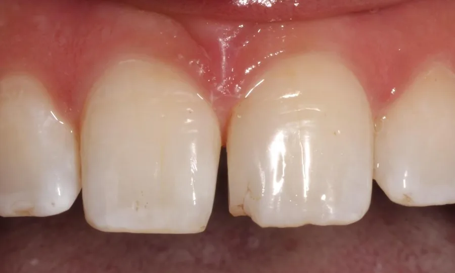 Before: chipped front teeth