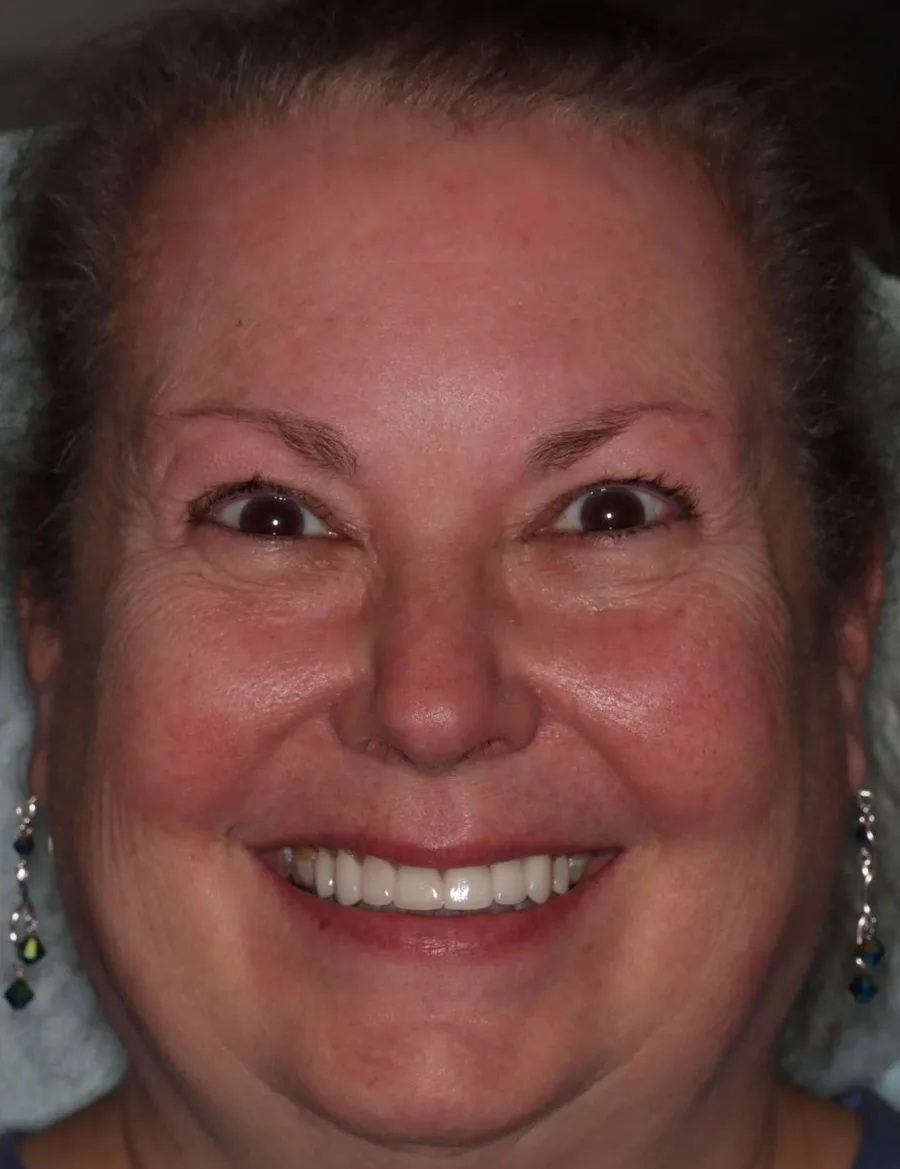 After: the smile makeover