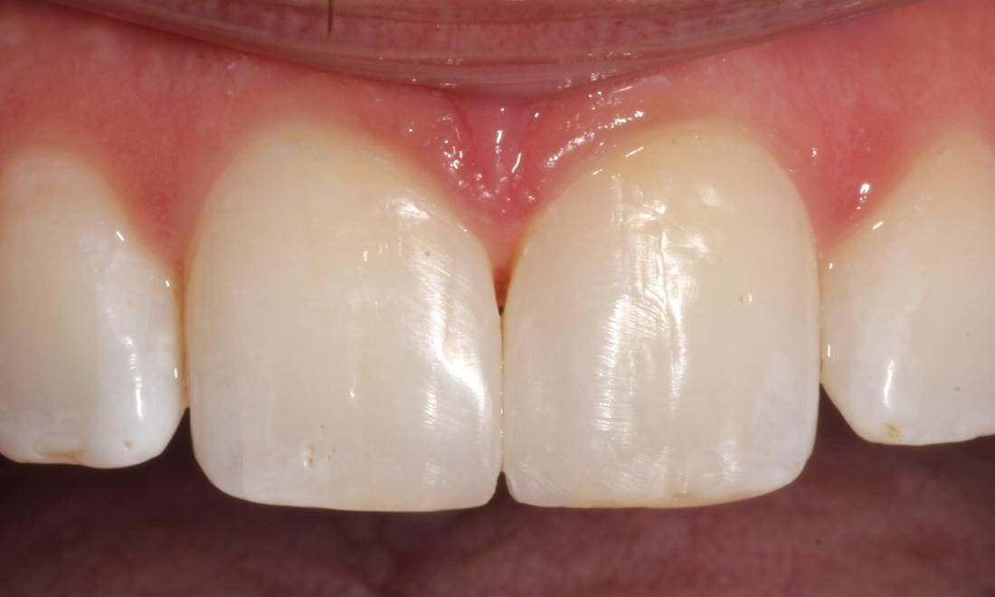 After composite bonding