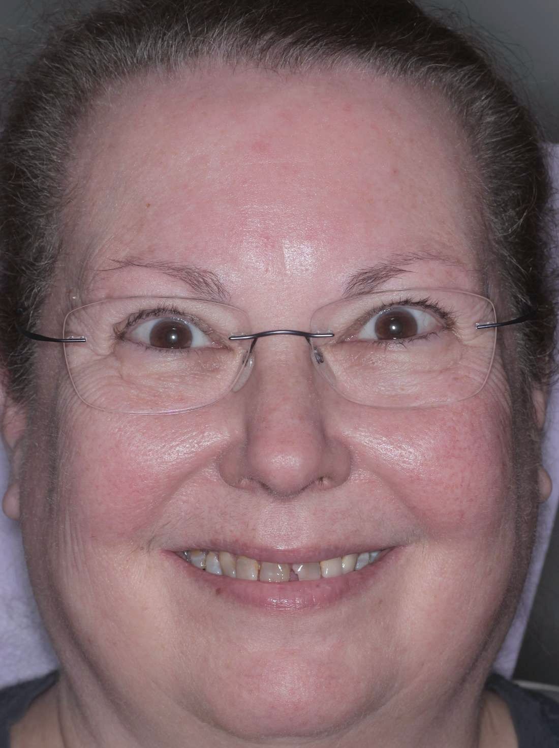 Before: chipped, worn and discolored teeth