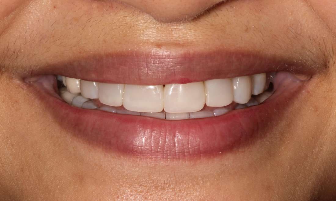 After Invisalign, whitening and composite veneers