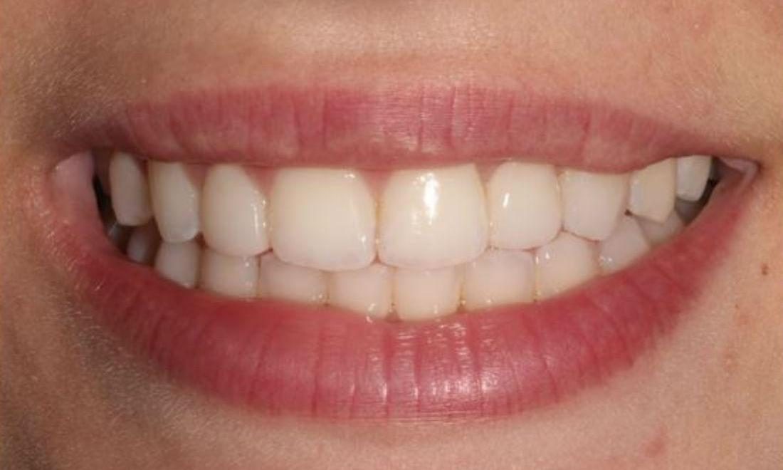 After: a complete, even smile