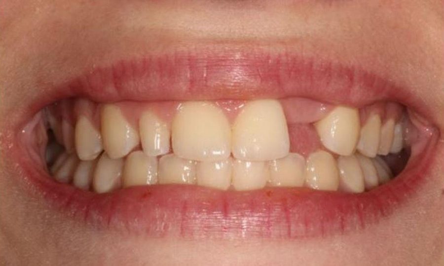 Before: a missing tooth beside the front teeth and a small peg-shaped tooth