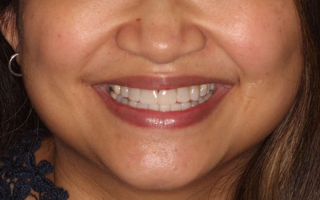 A patient's smile after Invisalign, whitening and composite veneers