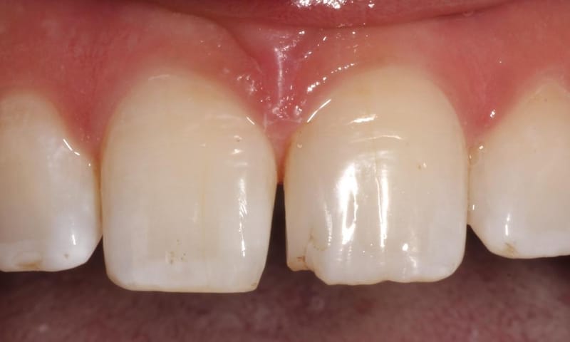 Before: chipped front teeth