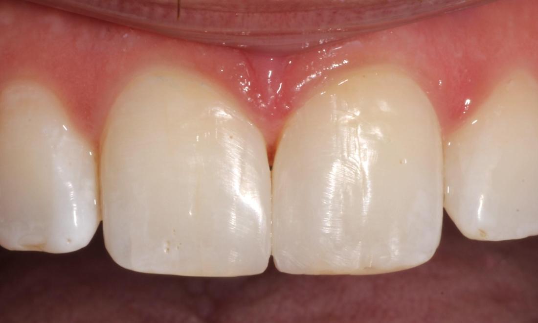 After: the same teeth repaired with composite bonding