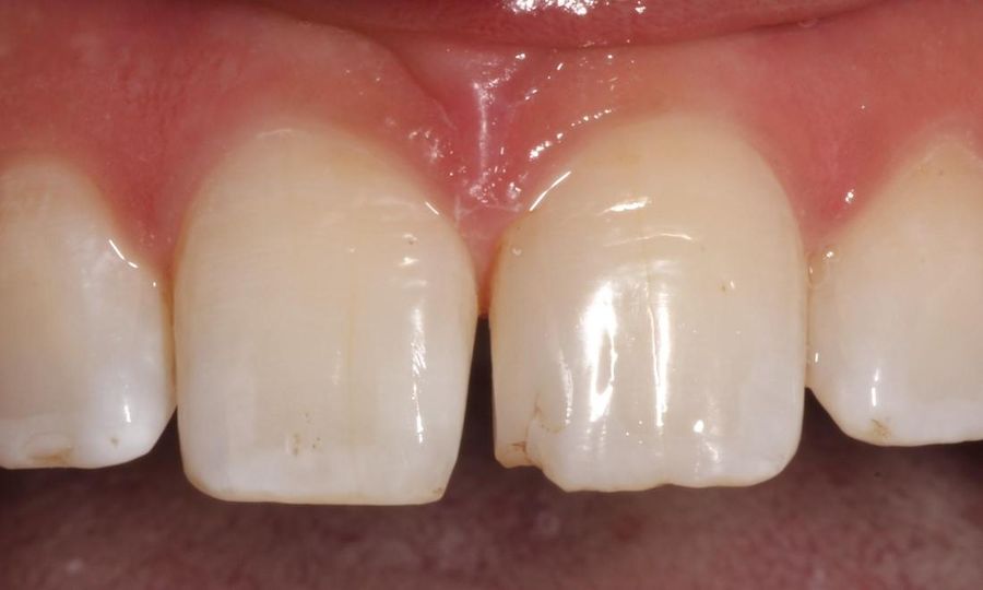 Before: chipped front teeth