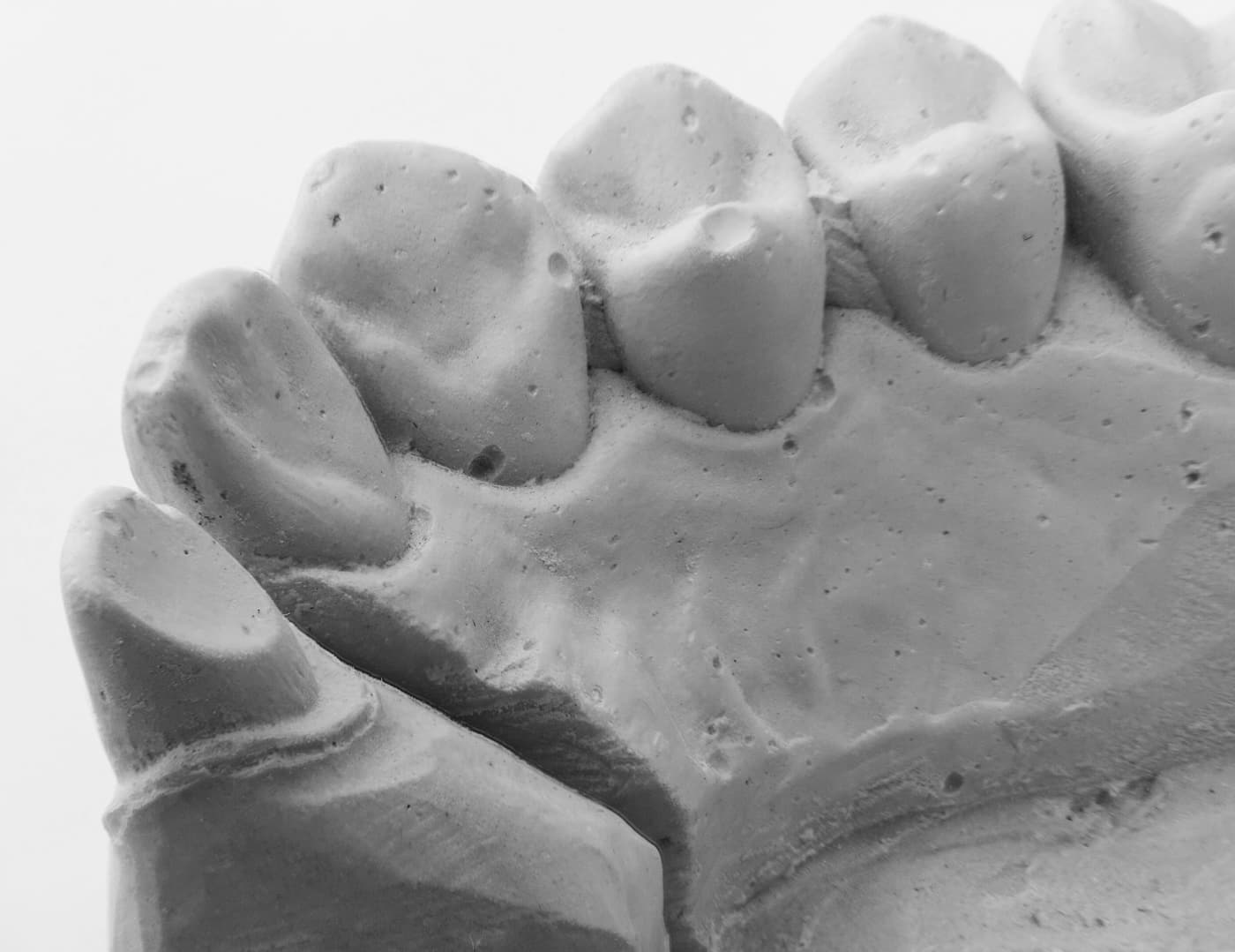 Close-up of a porcelain crown seated on a plaster model of teeth.