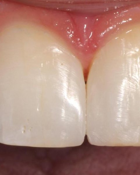Front teeth repaired with composite bonding
