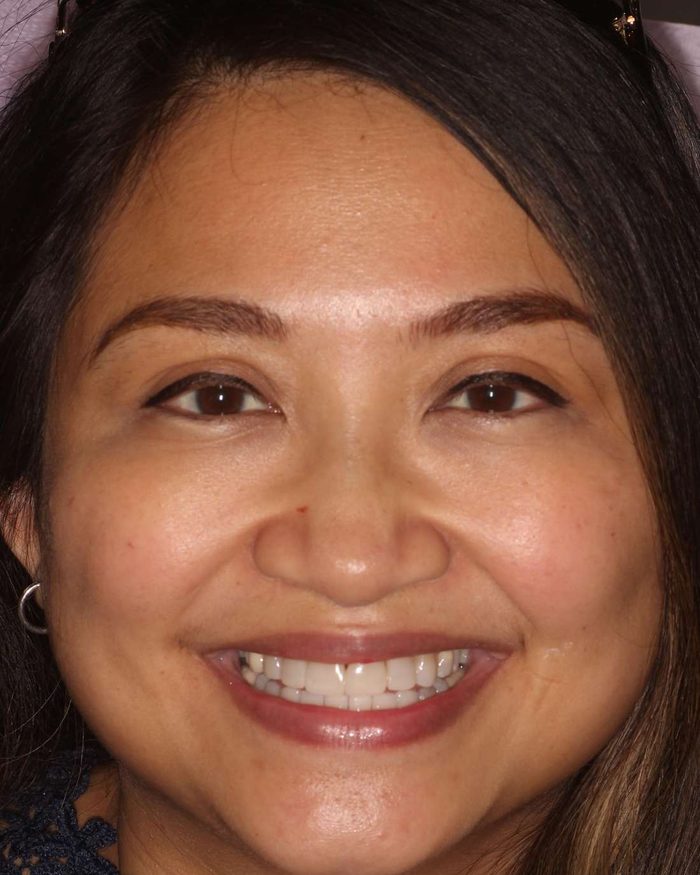 A patient's smile after her treatment, which started with Invisalign
