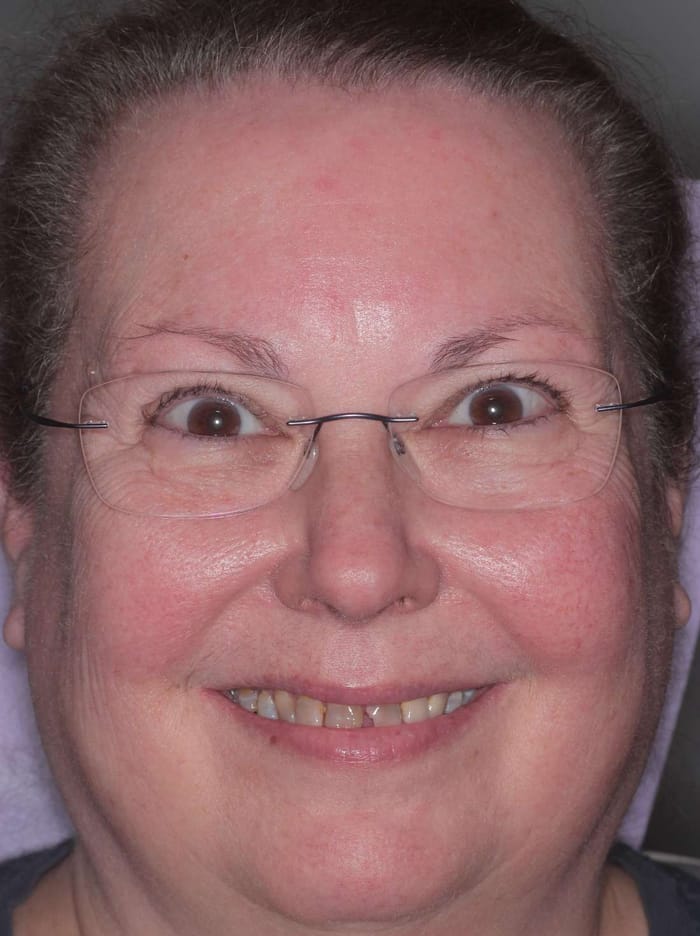 A woman's chipped, worn and discolored teeth before her smile makeover