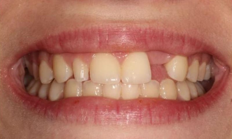 Before: a gap where a side tooth never grew, and a small peg tooth