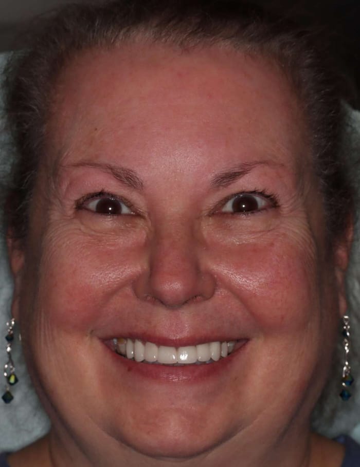 After: the same woman with her new, even smile