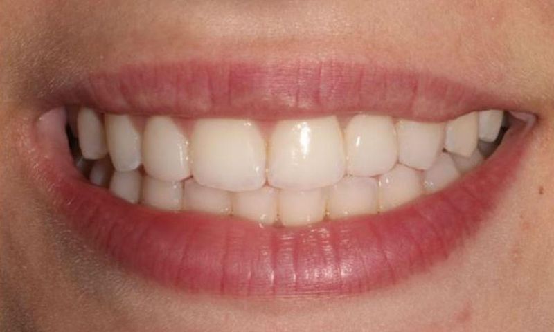 After: a full, even row of teeth