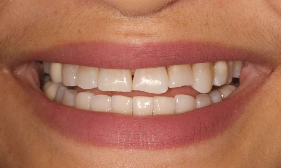 Front teeth before: an uneven bite and worn edges