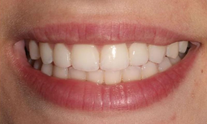 After: the gap a porcelain bridge