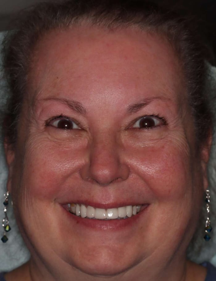 After: the same patient with her new smile