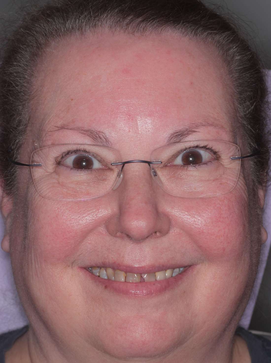 Before: chipped, worn and discolored teeth