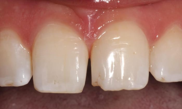Before: chipped front teeth