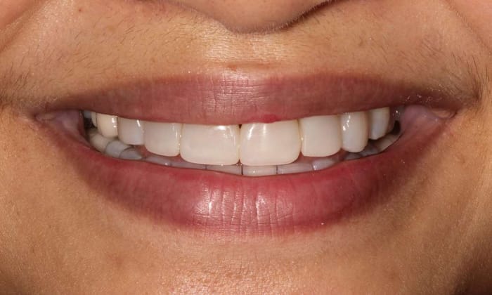 After: even, rebuilt front teeth
