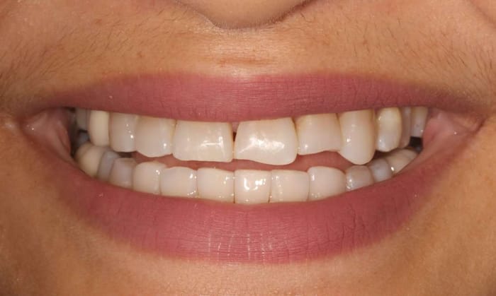 Before: uneven bite and worn front edges