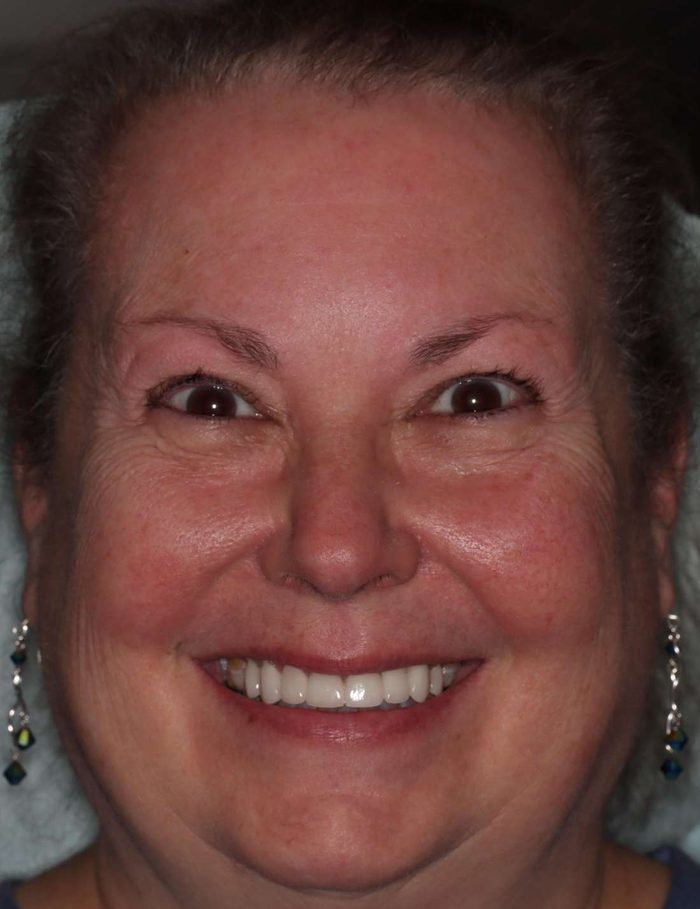 After: a smile makeover planned digitally