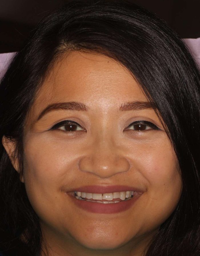 Before: an uneven bite and worn front edges
