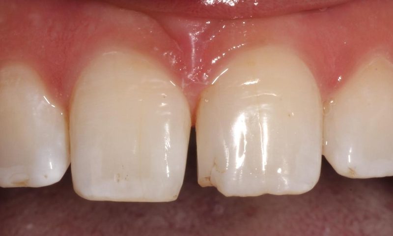 Chipped front teeth before bonding