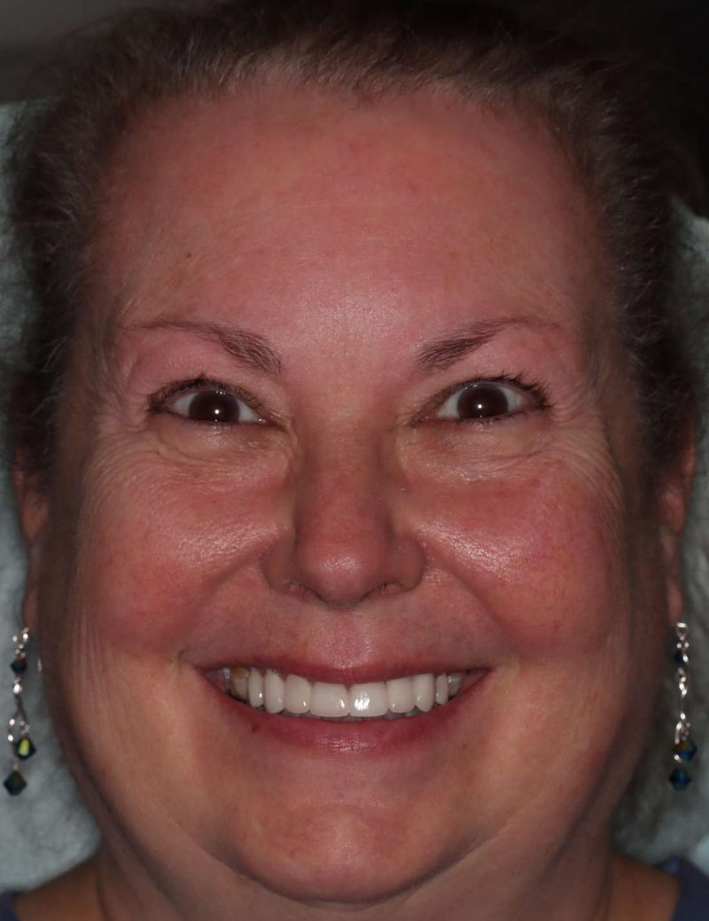The same patient after her smile makeover